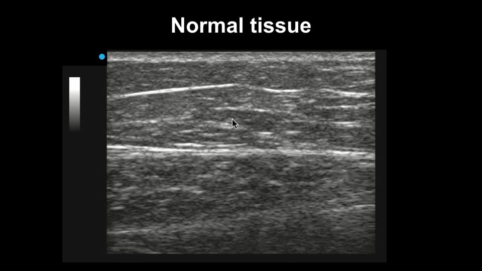 Soft tissue ultrasound for the diagnosis of abscesses and cellulitis
