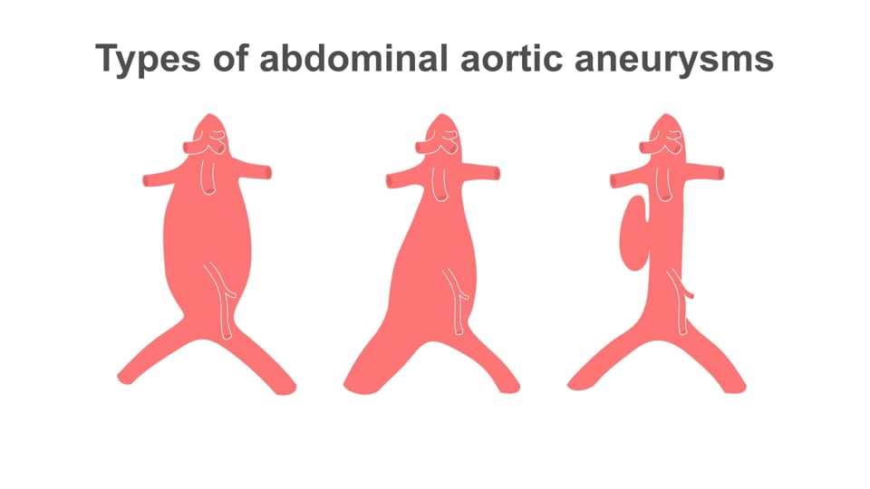 Evaluating for abdominal aortic aneurysm
