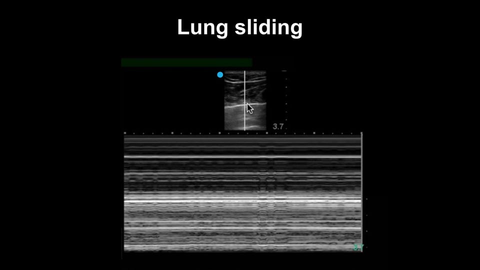Evaluating for pneumothorax