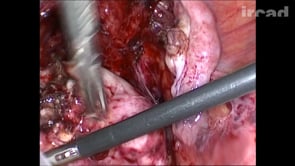 Ooforectomia por video / Video Oophorectomy 