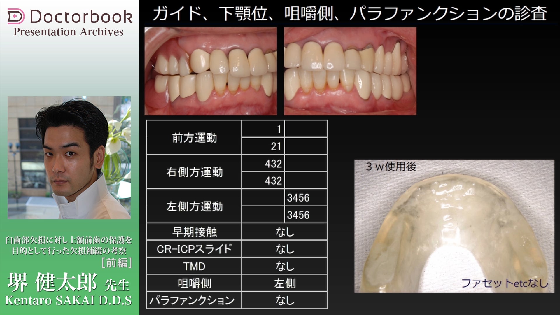 臼歯部欠損に対し上顎前歯の保護を目的として行った欠損補綴の考察（前編）