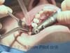 The Implant, A procedure by Dr Paul Palmer