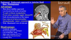 Endoscopic approach to anterior skull base meningiomas: current ...