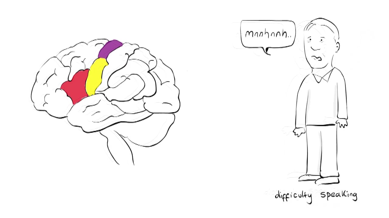 Health Sketch What is a Stroke? Animated Explanation Video on Vimeo