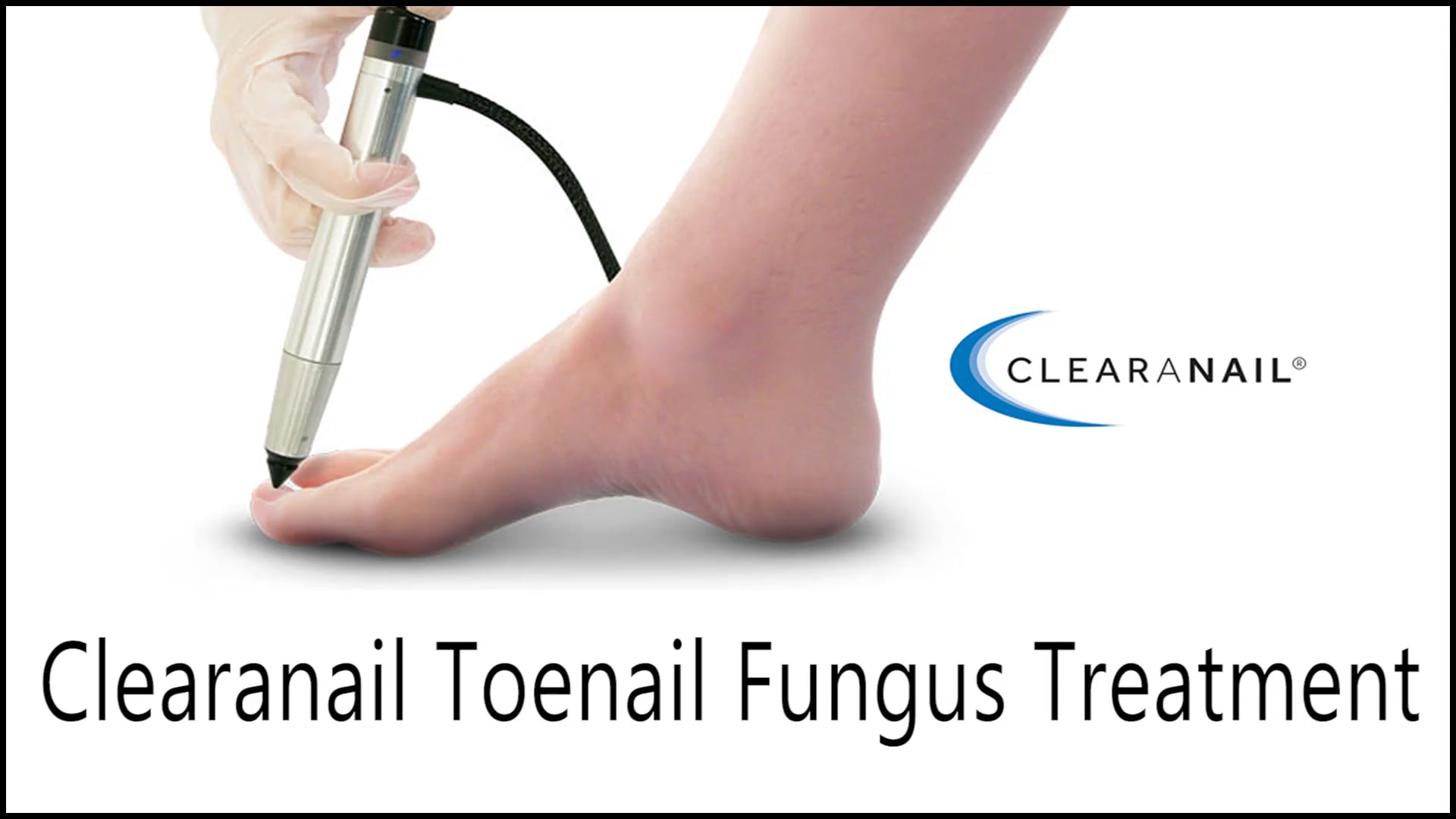 Clearanail’s® For Toenail Fungus - Improve Your Treatment & Results For ...