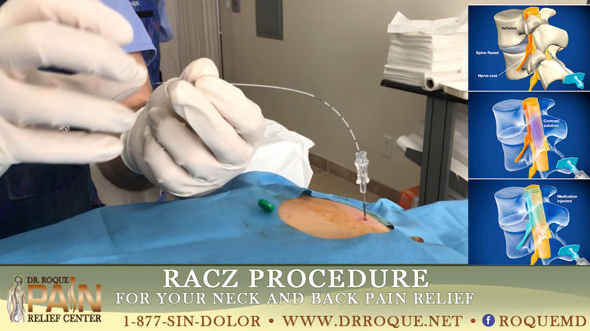 cervical racz procedure on Vimeo