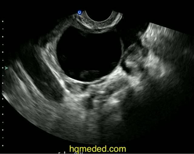 Ultrasonography Ovarian Cyst On Vimeo 9026