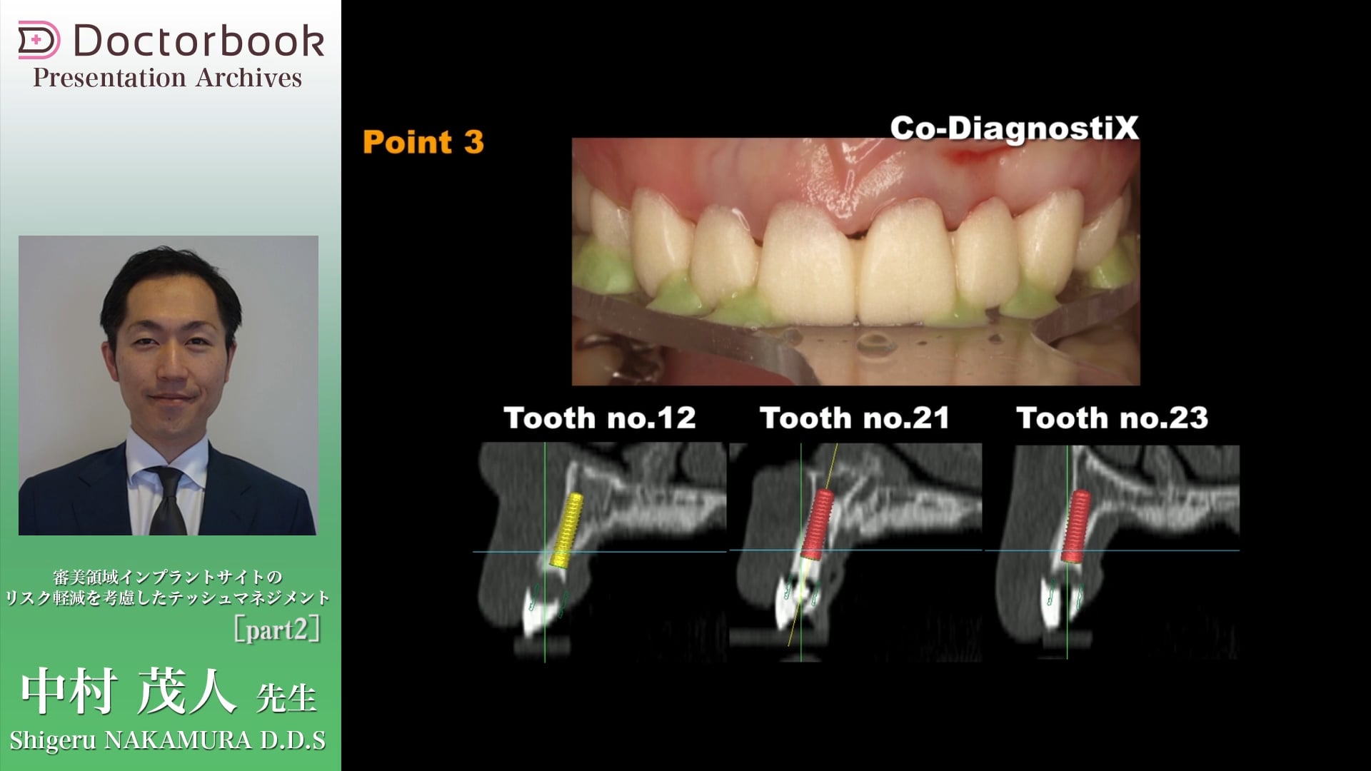#2 単独インプラントと矯正の併用 / 複数歯インプラント