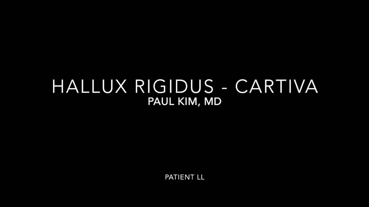 Hallux Rigidus Treated Using The Cartiva Implant On Vimeo