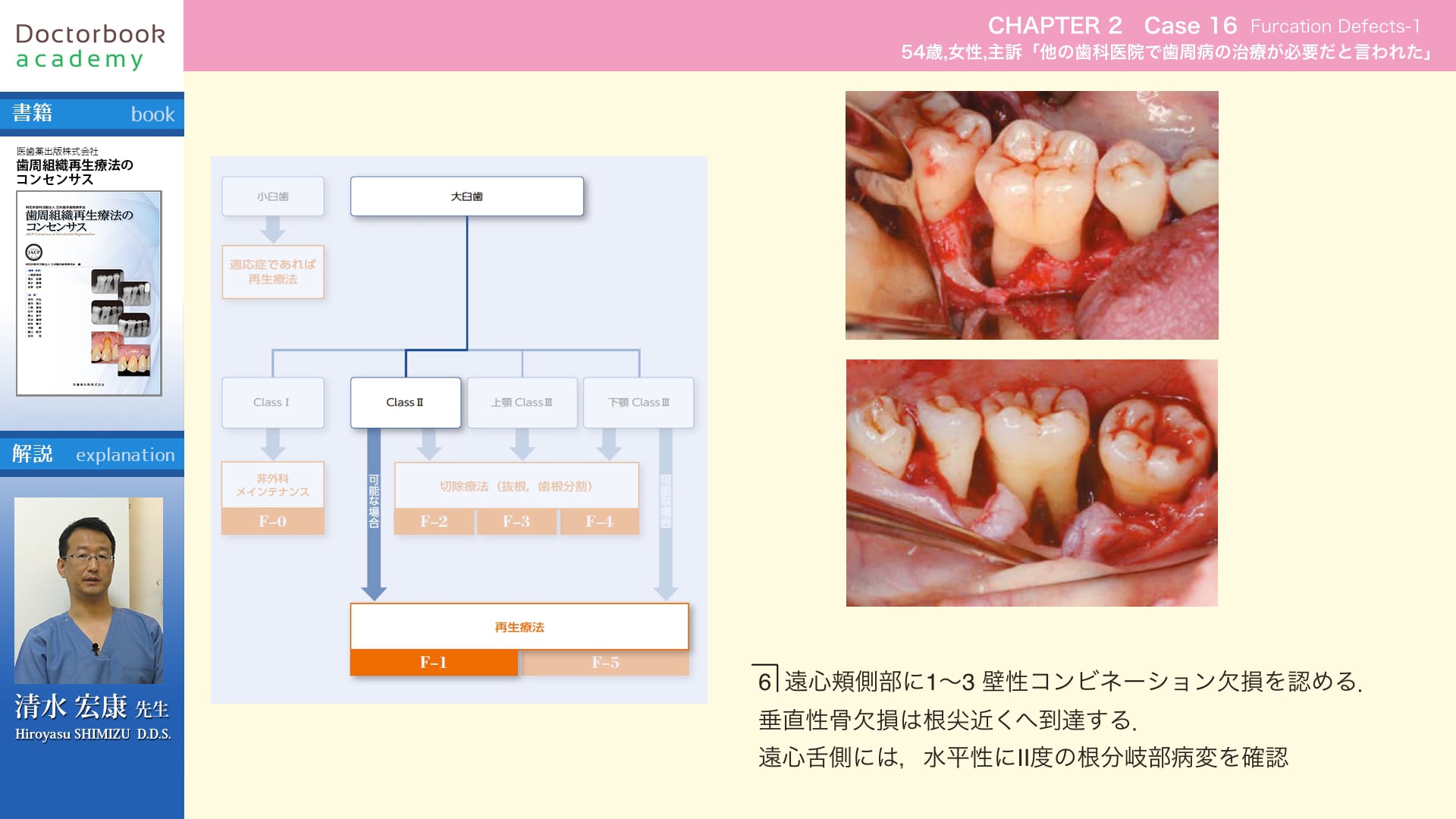【BookReview】『歯周組織再生療法のコンセンサス』#2