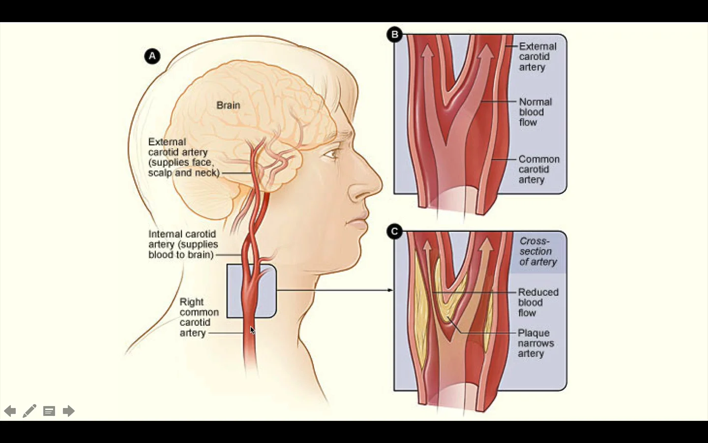 Спазм головы форум. Гипертензивная энцефалопатия патогенез. Спазм головы форум. Спазм сосудов шейного отдела симптомы. Спазмы сосудов головного мозга симптомы.