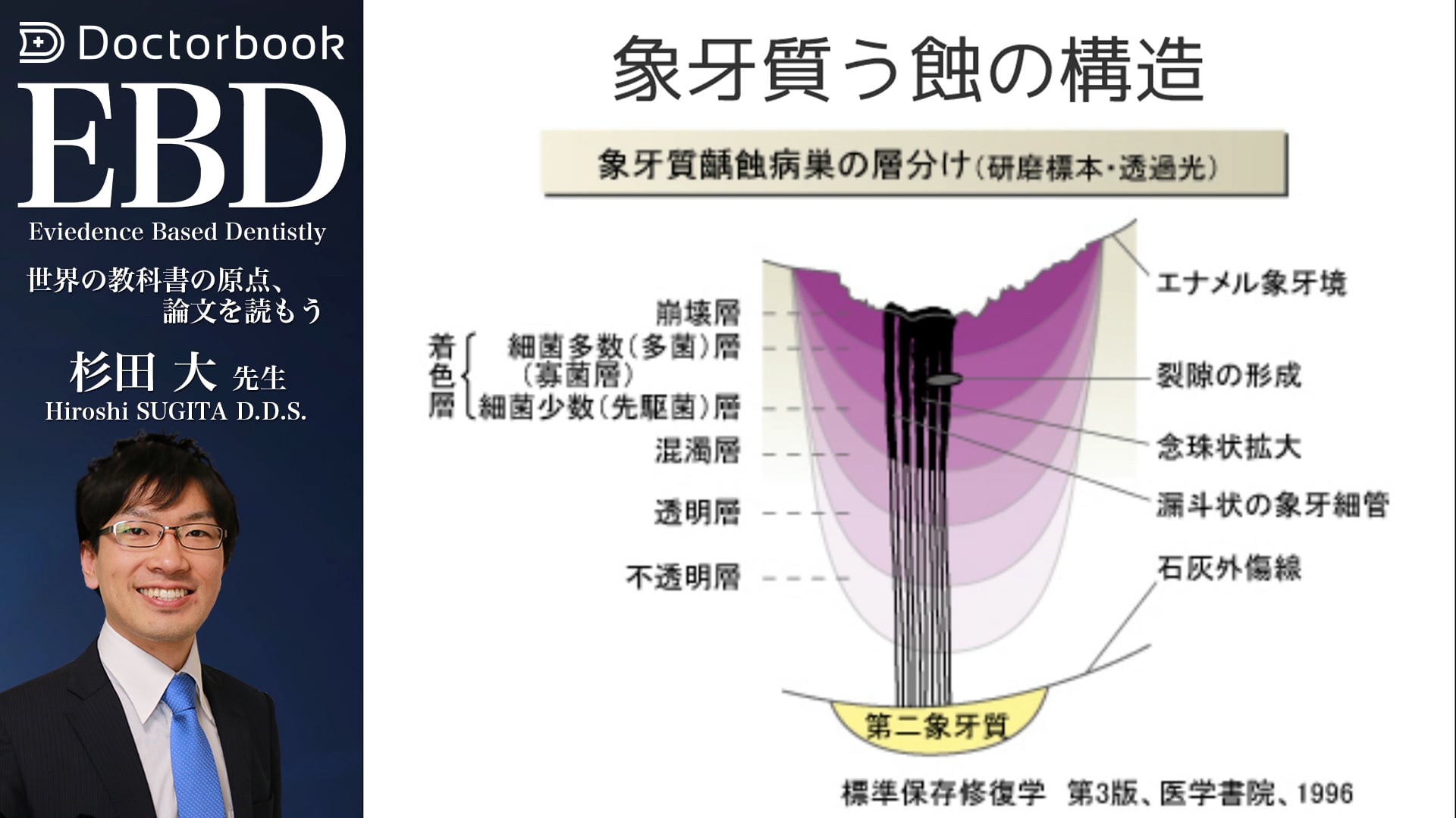 う蝕治療ガイドライン #2