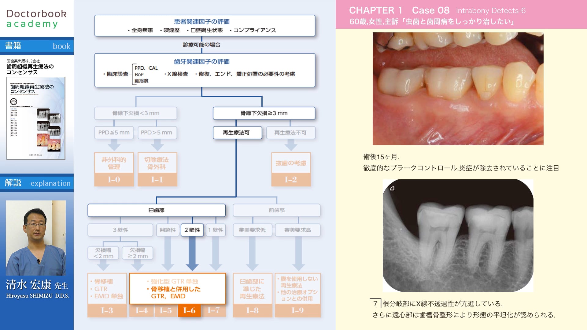 【BookReview】『歯周組織再生療法のコンセンサス』#1