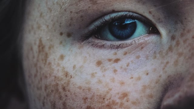 freckles all over body