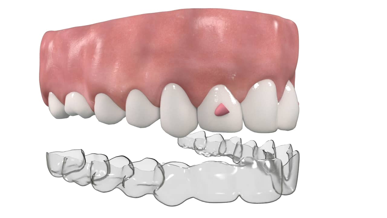 Graham Studios - Invisalign Animation on Vimeo