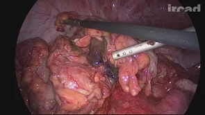 Buscar | WebSurg, the online university of IRCAD