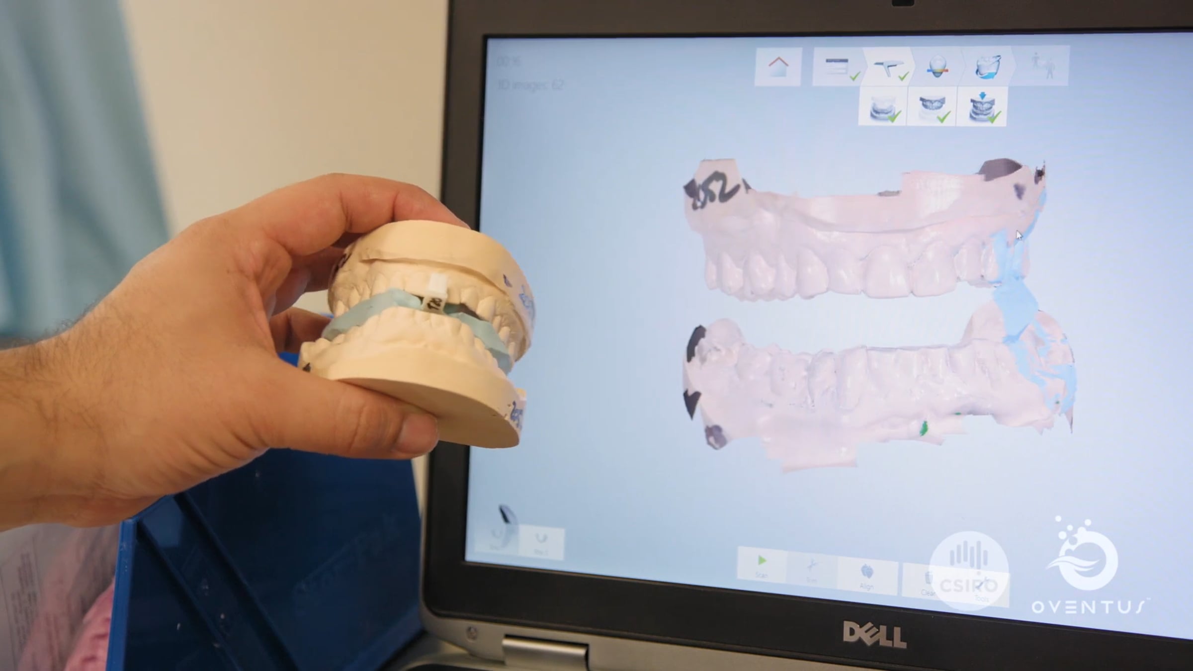 Introducing the OVENTUS O2 Vent™ Oral Appliance | Videos & Movies on Vimeo