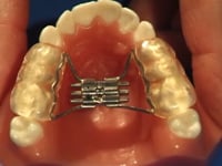 Bonded RPE Adjustment