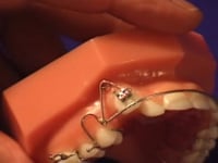 Cuspid Retraction Spring Adjustment