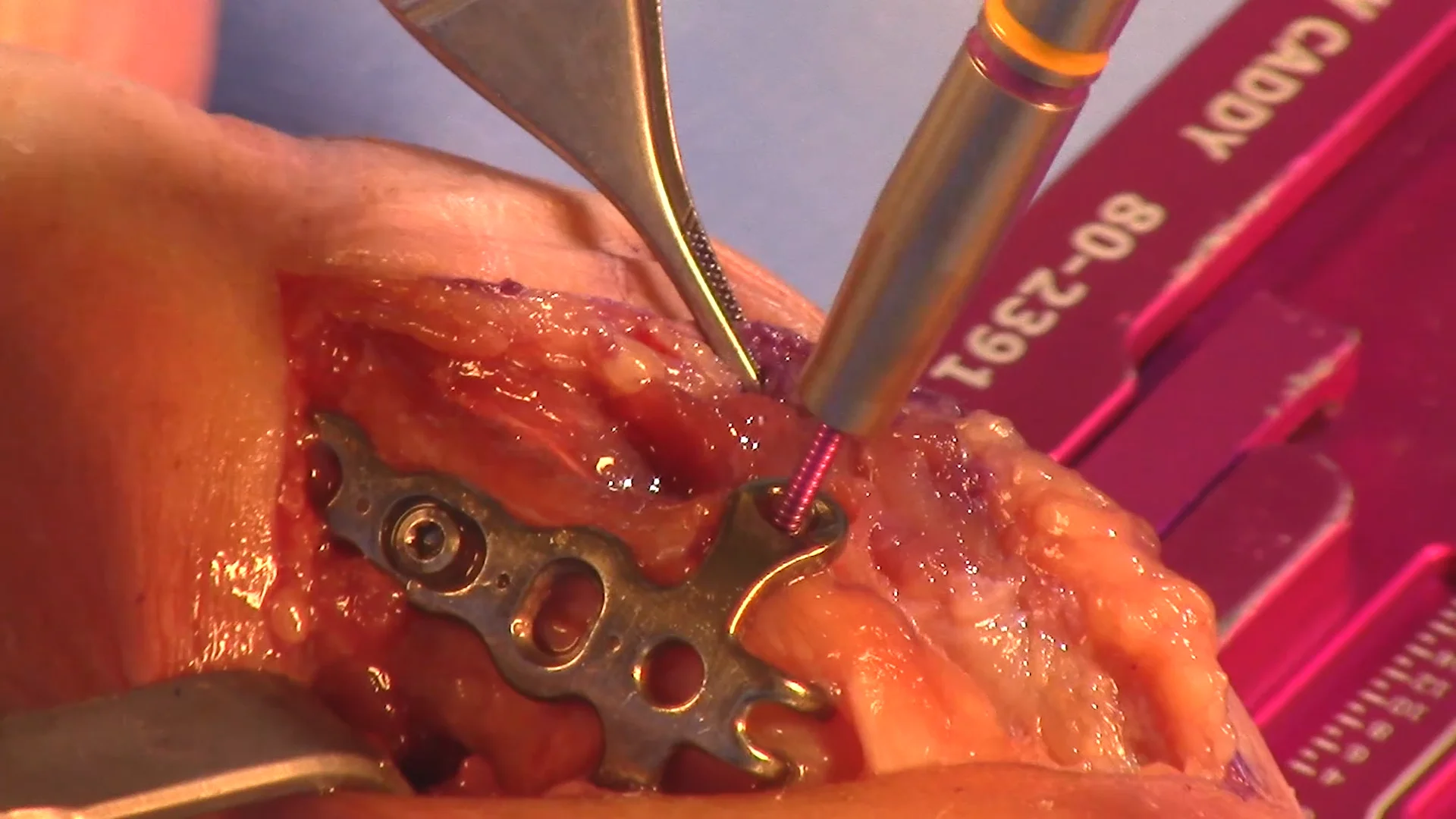Hand Fracture System Cadaveric Lab Part 2: Rolando Fracture Hook Plate on  Vimeo