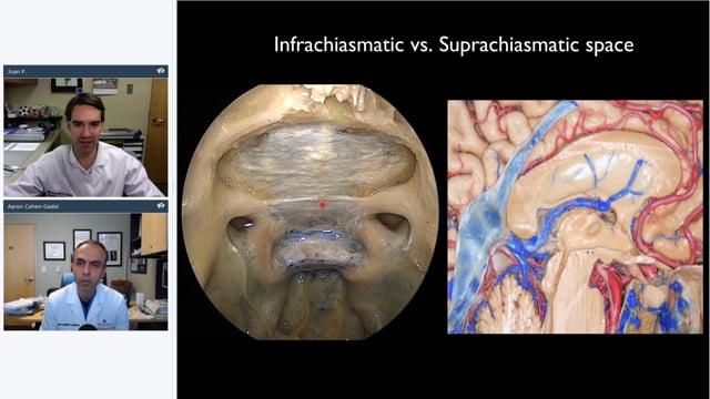 Grand Rounds: Endoscopic Endonasal Anterior Skull Base Surgery-Anatomy and  Surgical Correlates