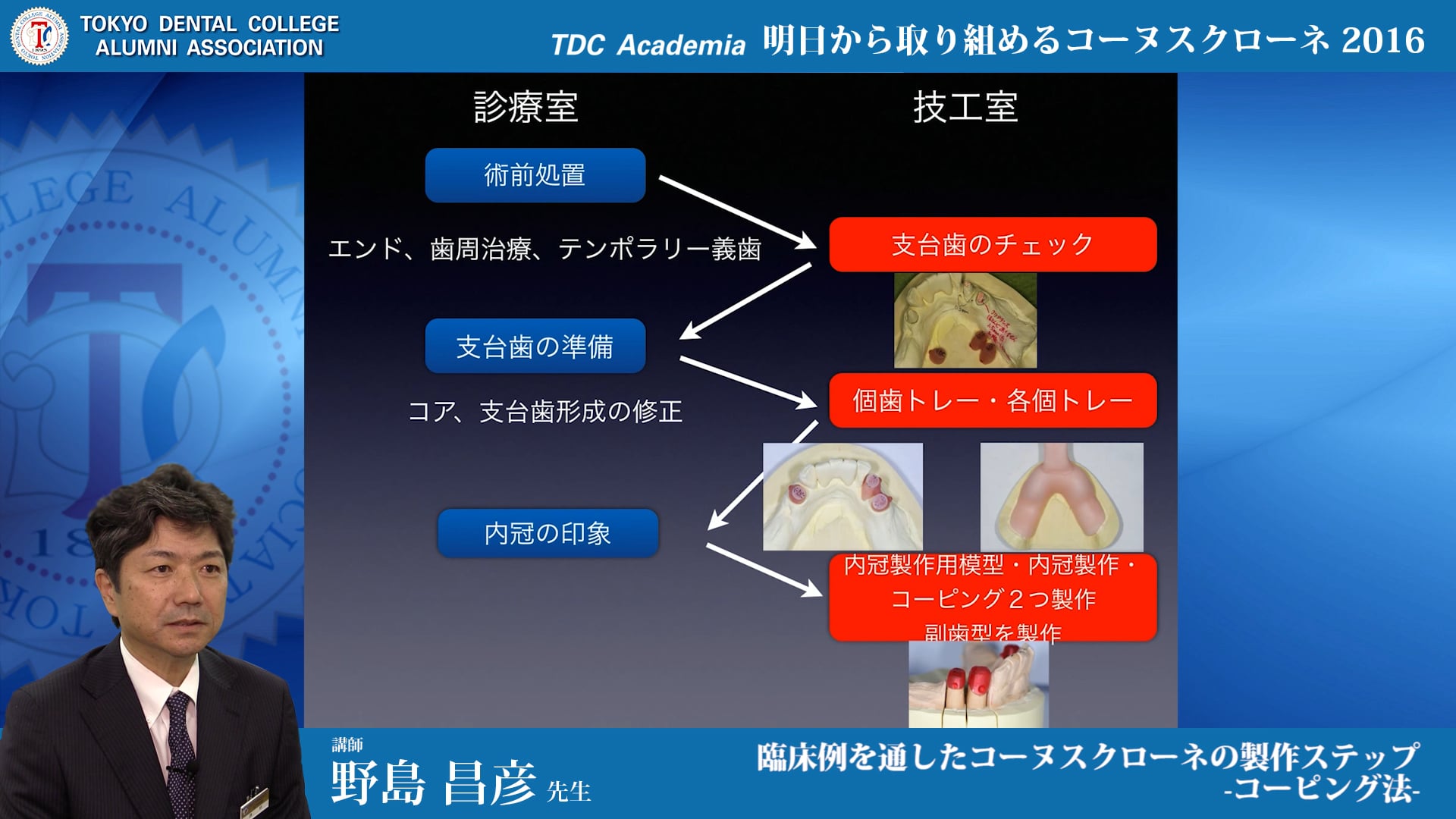 臨床例を通したコーヌスクローネの製作ステップ - コーピング法 - 