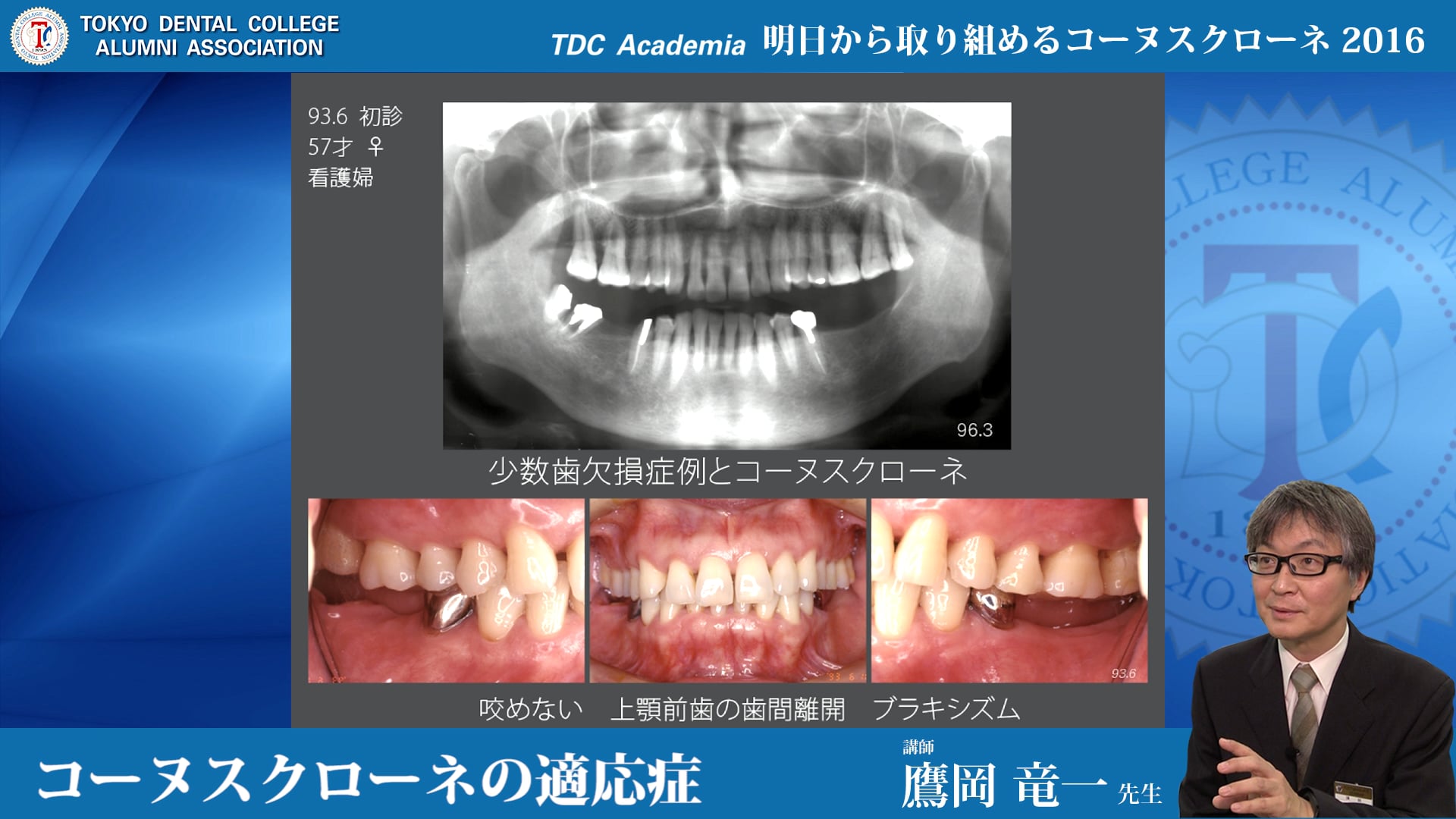 コーヌスクローネの適応症