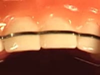 Flat Labial Bow Adjustment