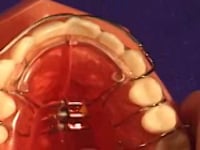 Labial Bow Adjustment
