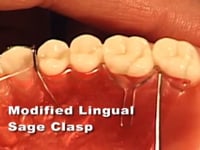 Lingual Retention Clap Adjustment