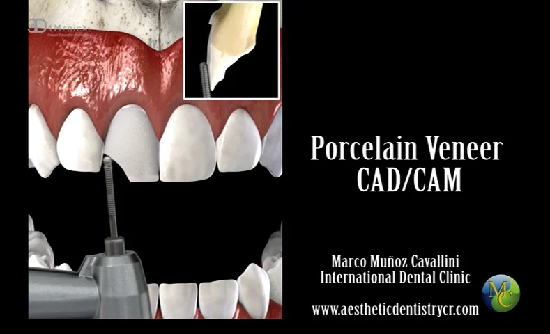 Porcelain Veneer CAD CAM on Vimeo
