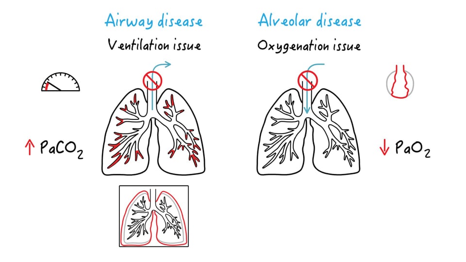 Alveolar disease