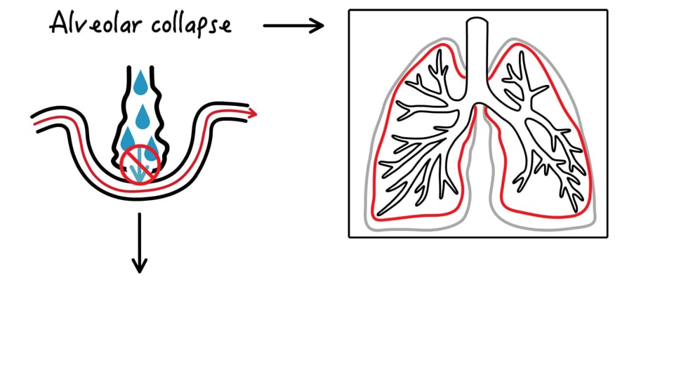 Acute Respiratory Distress Syndrome (ARDS)