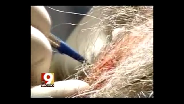 Hair Transplant-Micro-Follicular | Advanced Cosmetic Cincinnati