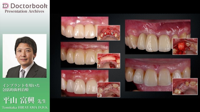 インプラントを用いた包括的歯科治療