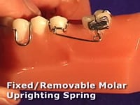 Molar Uprighting Spring Combo Appliance Adjustment