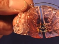 Posterior Acrylic Bite Plane Removal Adjustment