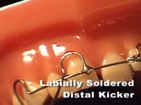 Posterior Distal & Mesial Kicker Spring Adjustment