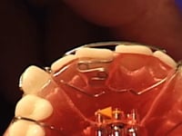Recurve Finger Spring Adjustment