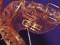 Sagittal Expansion Screw Adjustment