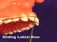 Slidling Labial Bow Adjustment
