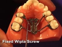 Spider- Whipla Adjustment