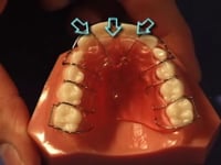 Upper Lingual Acrylic Adjustment