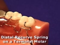 Uprighting Molar Spring Adjustment