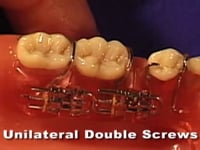 Molar Distalizing Screw Adjustment