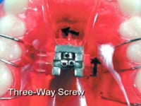 3-Way Expansion Screw Description