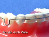 Acrylic Covered Labial Bow Description
