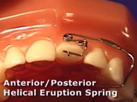 Anterior & Posterior Eruption Springs Adjustment