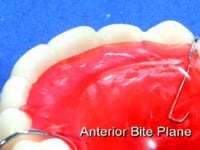Anterior Bite Plane Discription