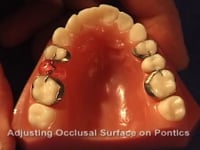 Banded Pontic Description